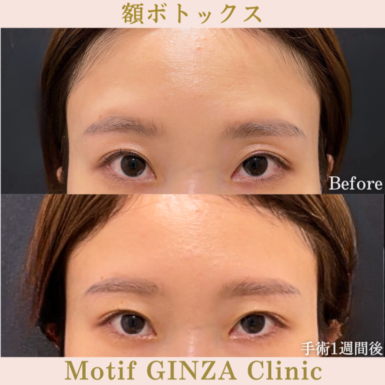額ボトックス（手術1週間）