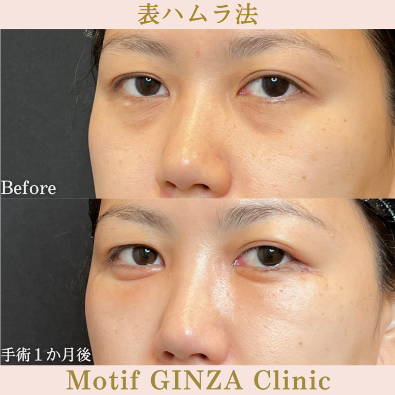 表ハムラ法（手術３か月）の写真4