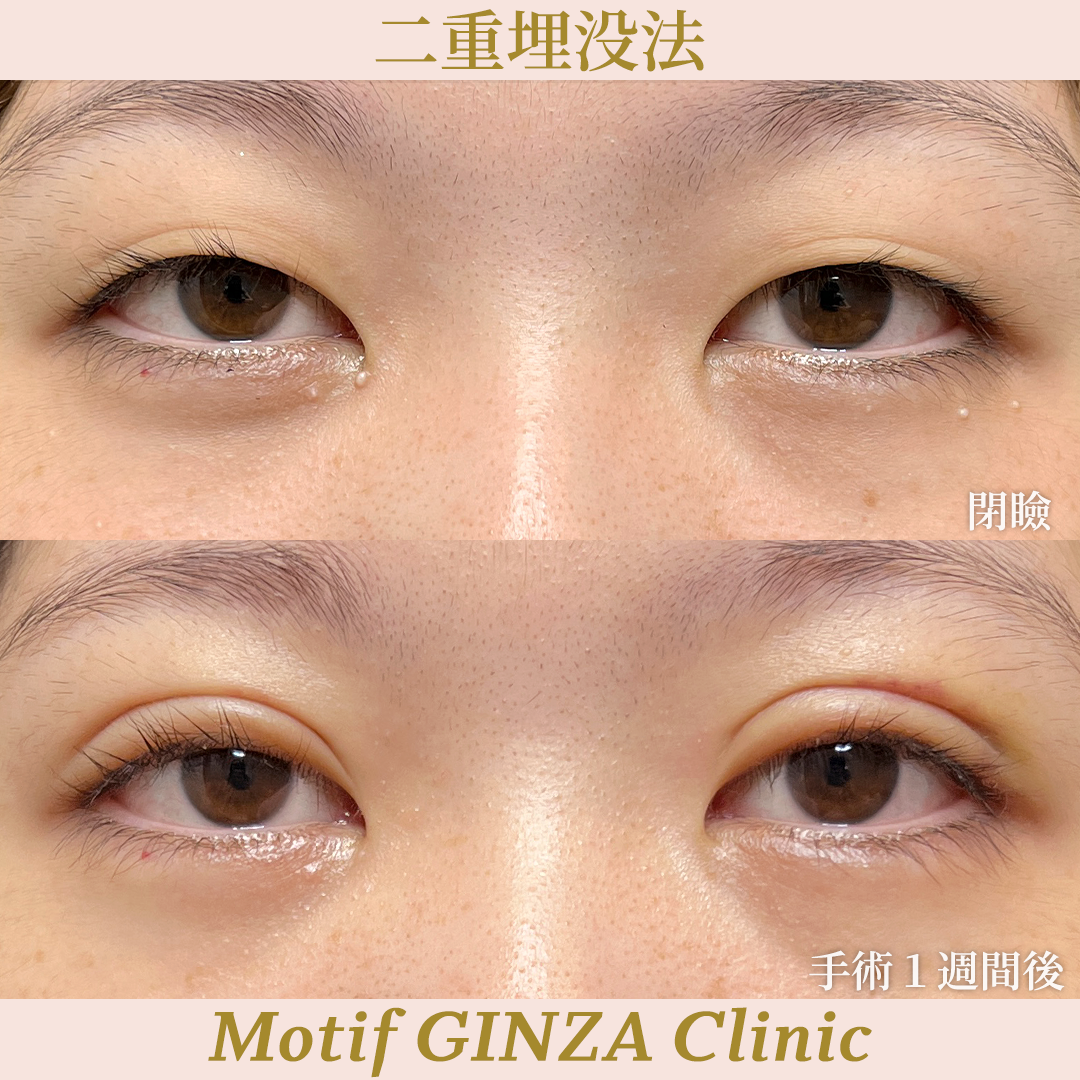 二重埋没法（手術１ヶ月）の写真3
