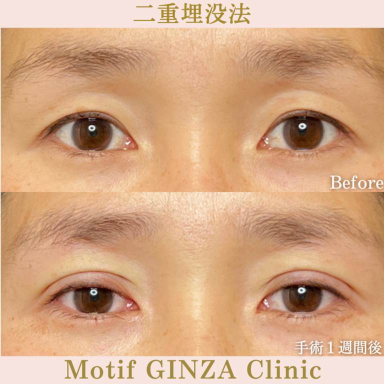 二重埋没法(手術1か月)の写真2