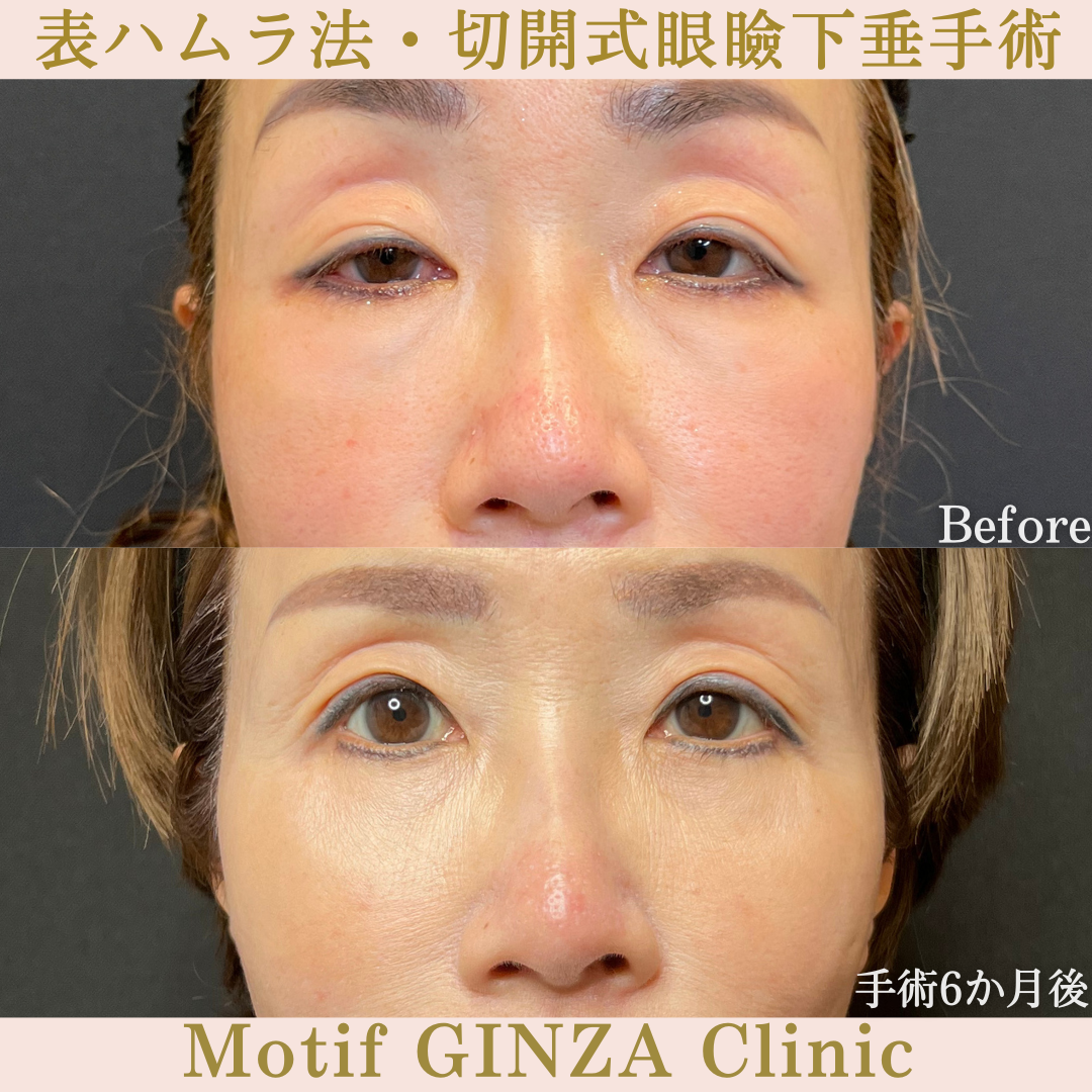 表ハムラ法・切開式眼瞼下垂手術（手術６ヶ月）の写真
