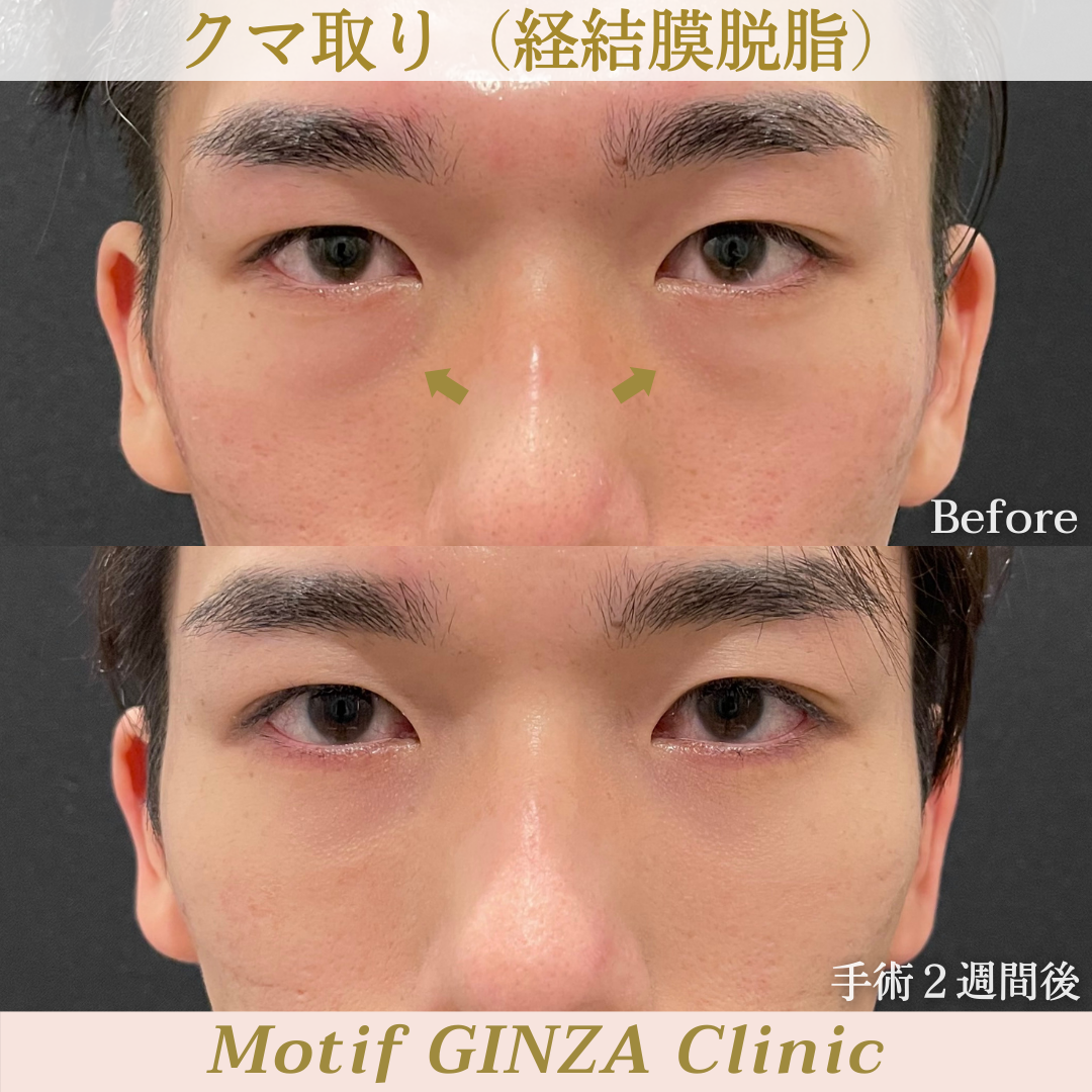 経結膜脱脂術(手術1ヶ月)の写真2
