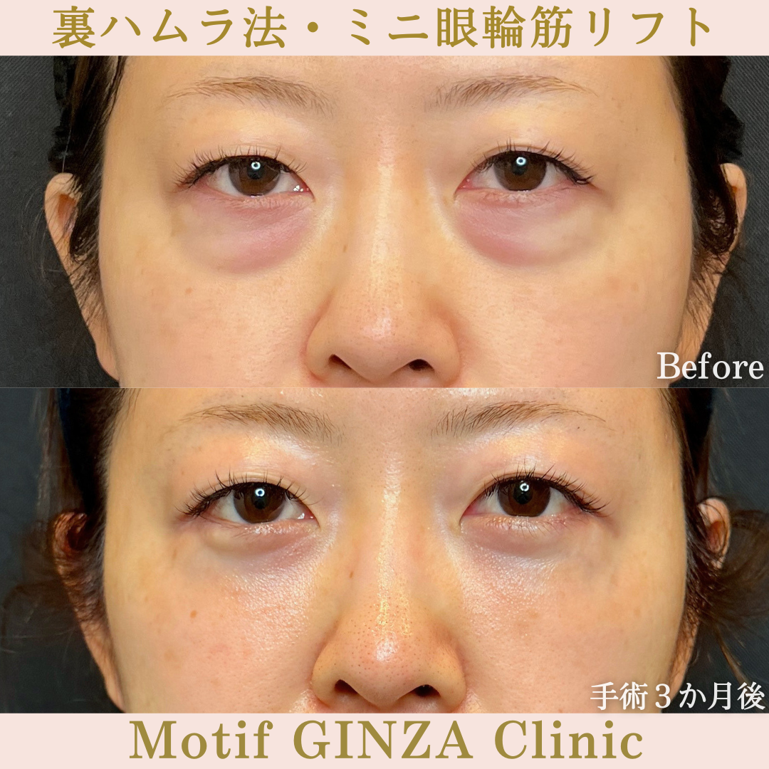 裏ハムラ法・ミニ眼輪筋リフト（手術6か月）の写真3
