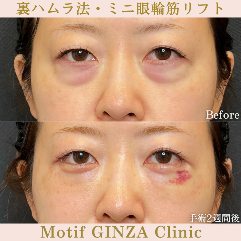 裏ハムラ法・ミニ眼輪筋リフト(手術1か月)の写真3