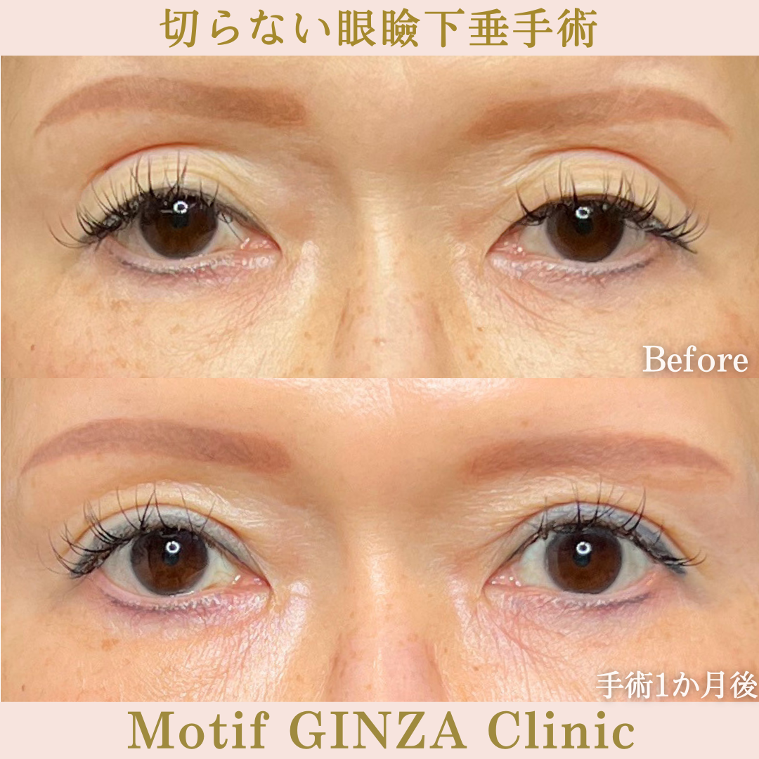 切らない眼瞼下垂手術（手術1か月）の写真