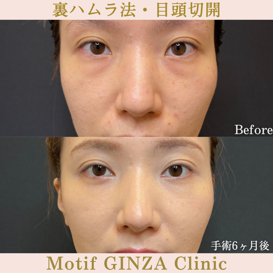 裏ハムラ法・目頭切開（手術６ヶ月）の写真