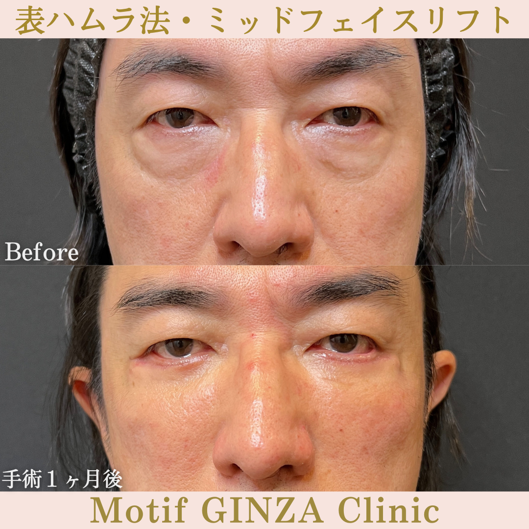 切開式下眼瞼たるみ取り・ミッドフェイスリフト(手術6ヶ月)の写真5