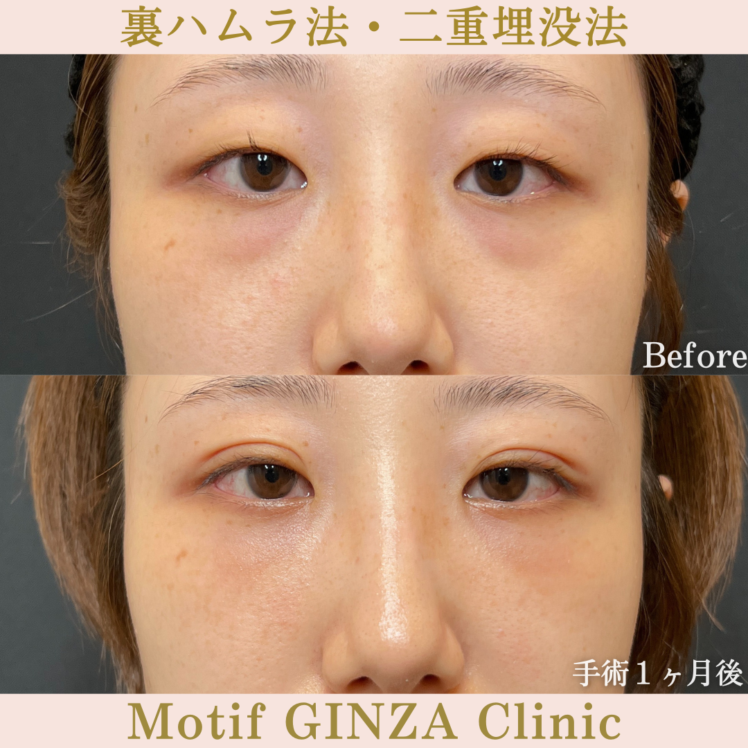 裏ハムラ法・二重埋没法(手術2年3ヶ月)の写真5