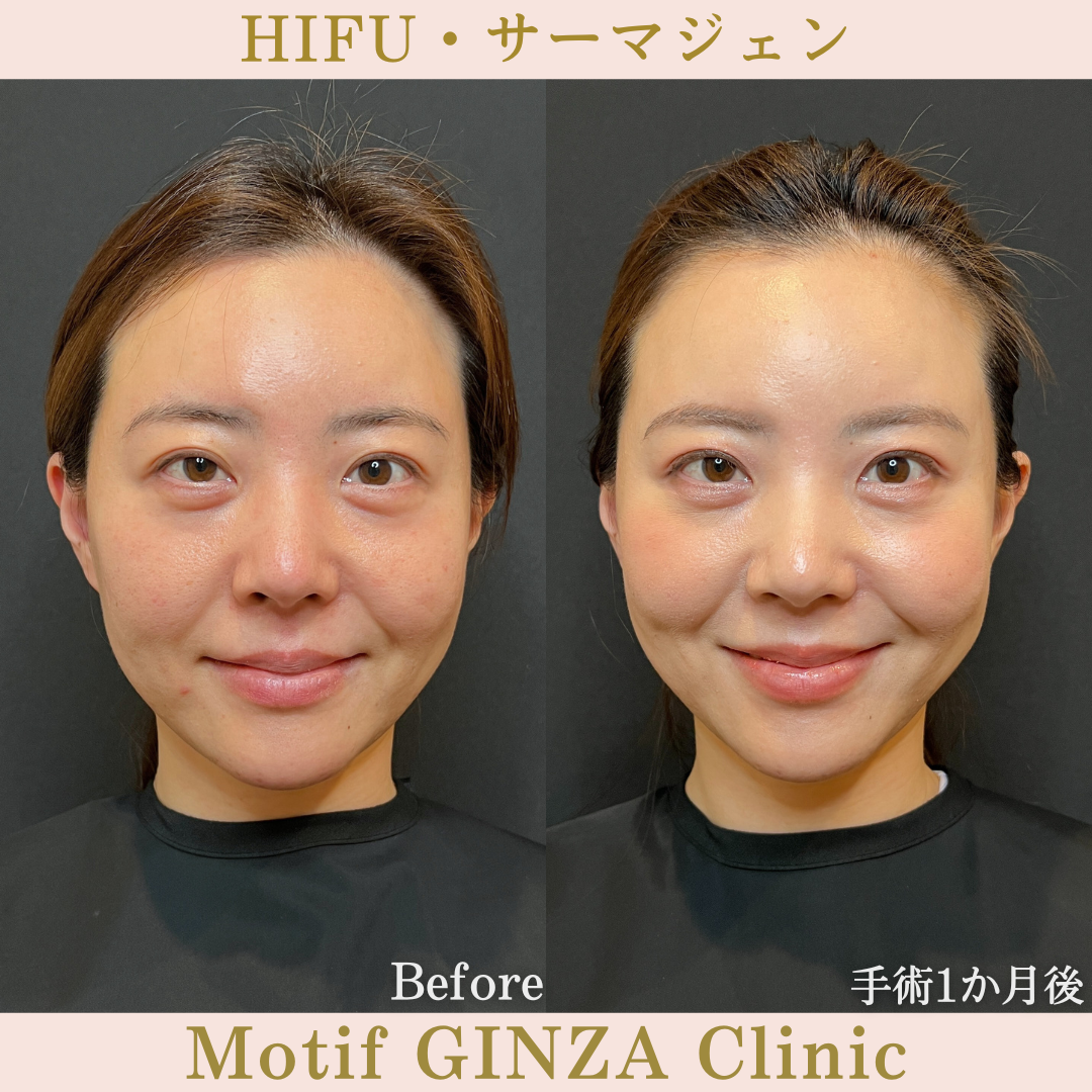 HIFU・サーマジェン（手術１か月）の写真