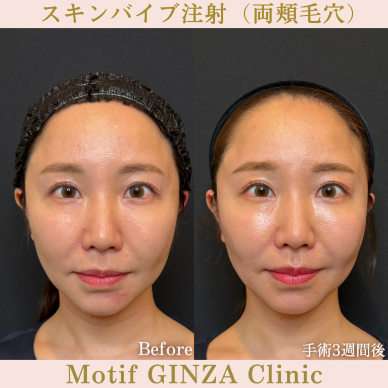 スキンバイブ注射（頬毛穴）（手術3週間）の写真2