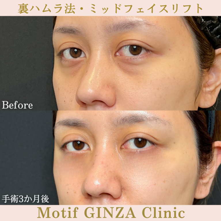 裏ハムラ法・ミッドフェイスリフト(手術5か月)の写真4