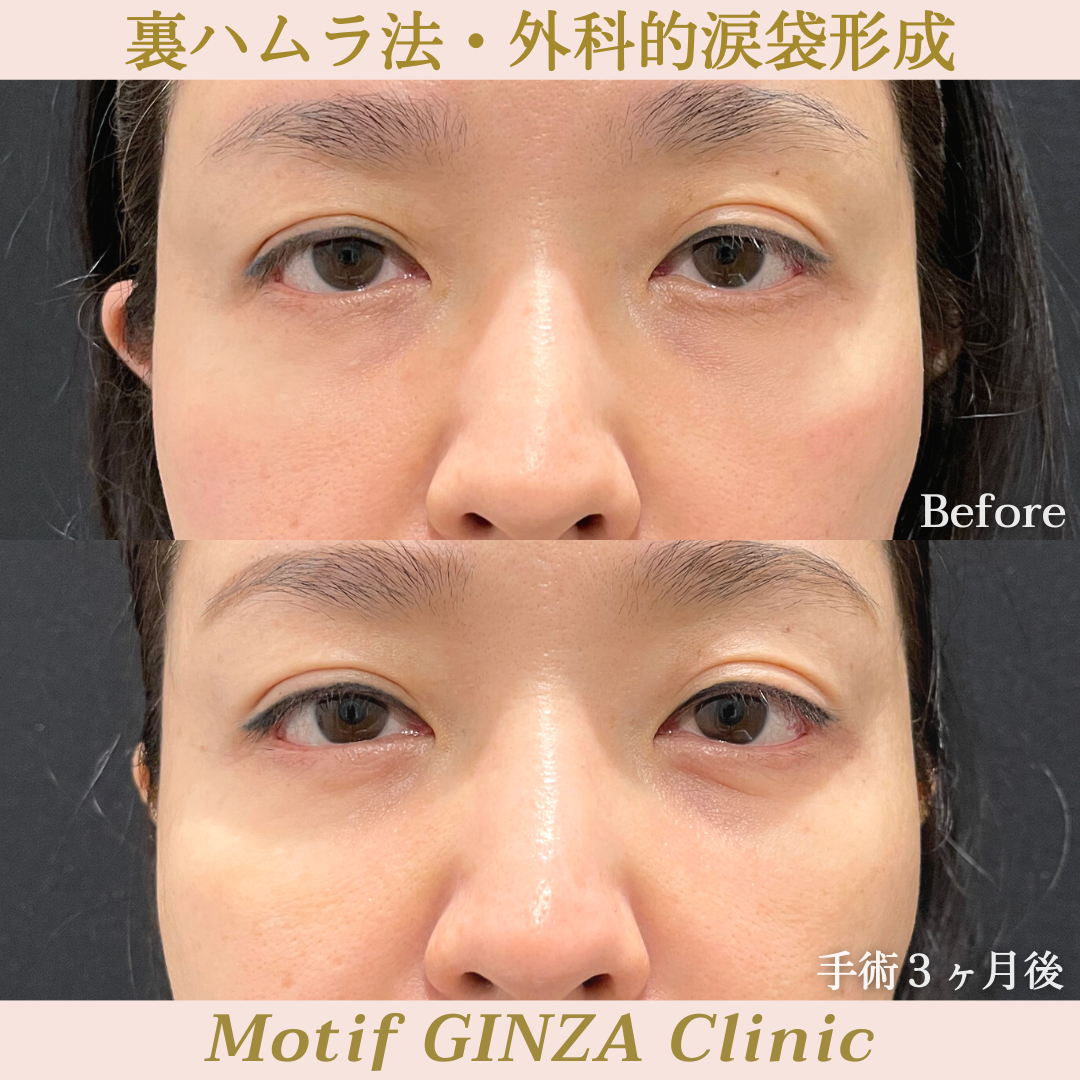裏ハムラ法・外科的涙袋形成（手術３ヶ月）の写真