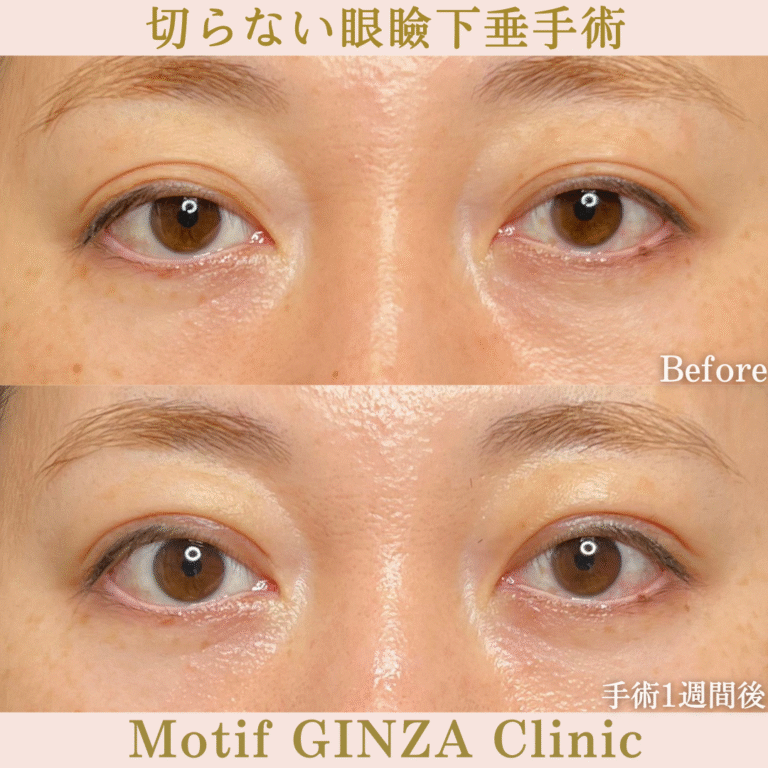 切らない眼瞼下垂手術（手術１か月）の写真2