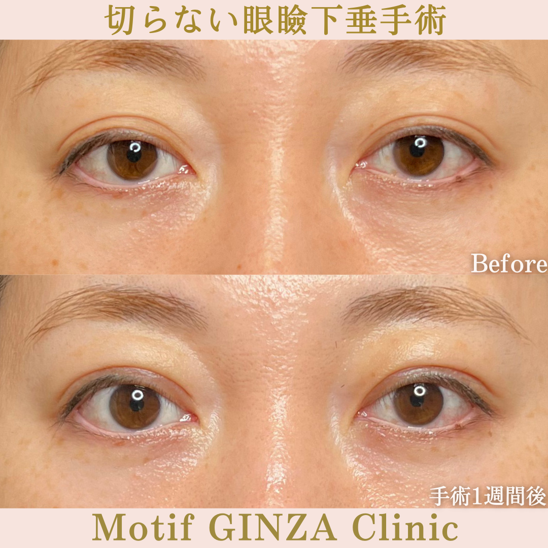 切らない眼瞼下垂手術(手術1か月)の写真2