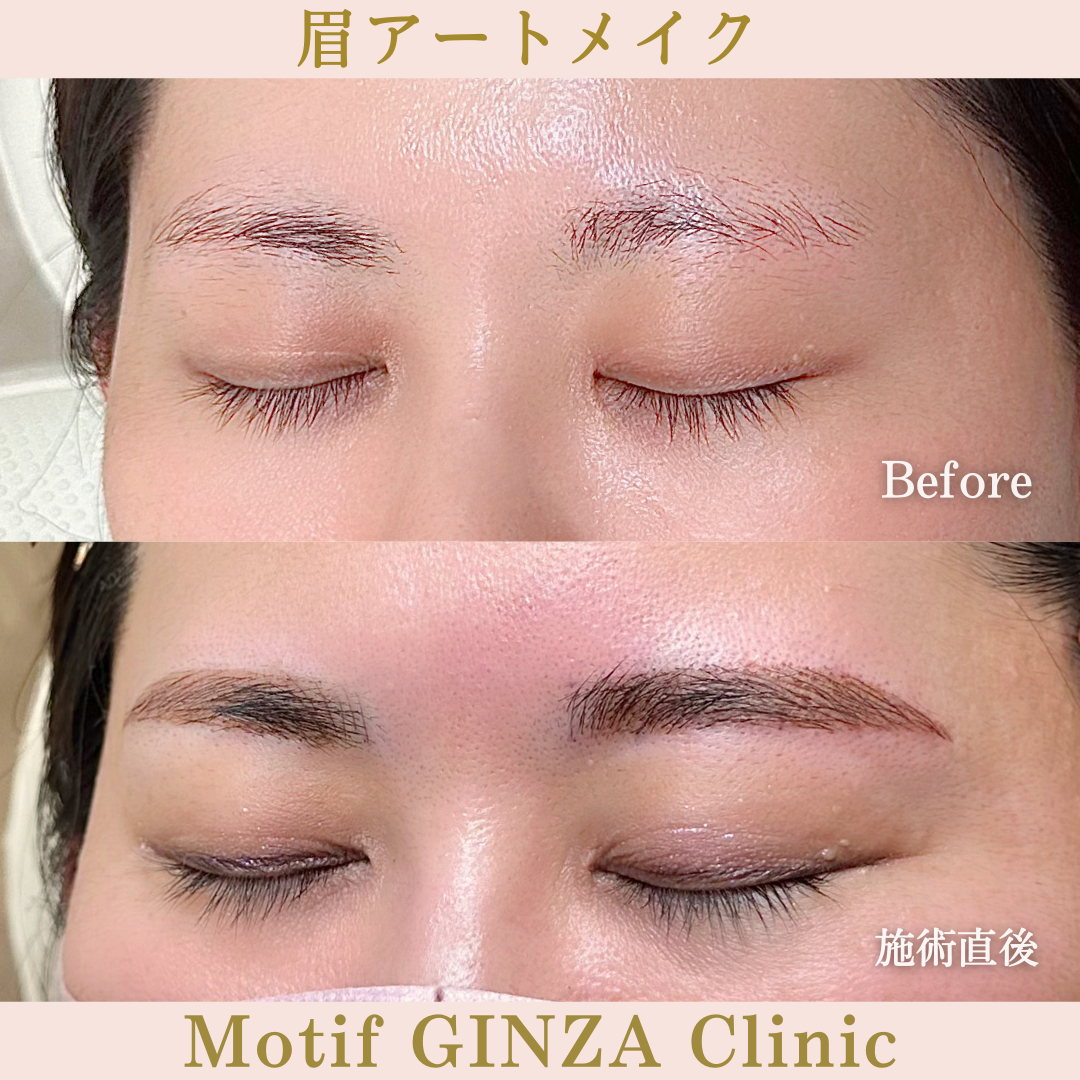 眉アートメイク（手術直後）の写真