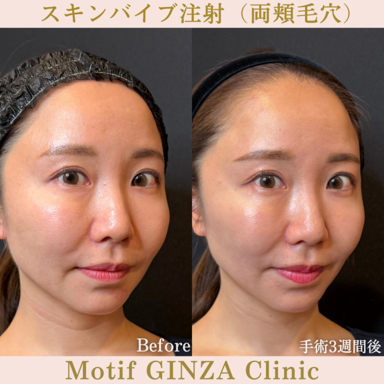 スキンバイブ注射（頬毛穴）（手術3週間）の写真3