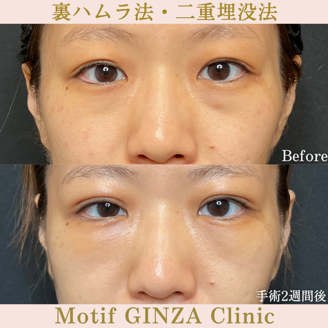 裏ハムラ法・二重埋没法（手術３か月）の写真5