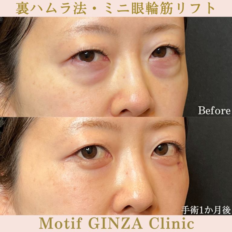 裏ハムラ法・ミニ眼輪筋リフト(手術1か月)の写真2