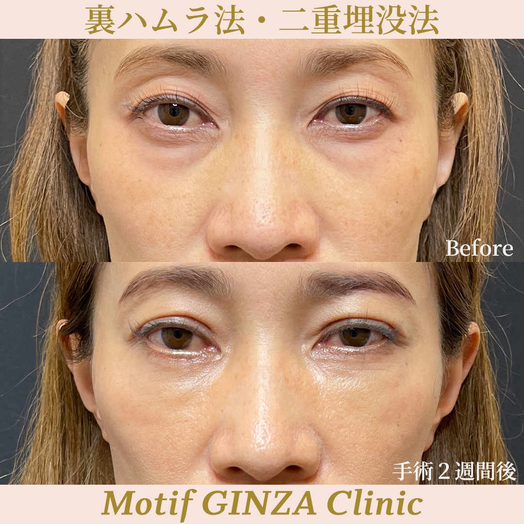 裏ハムラ法・二重埋没法（手術３ヶ月）の写真5