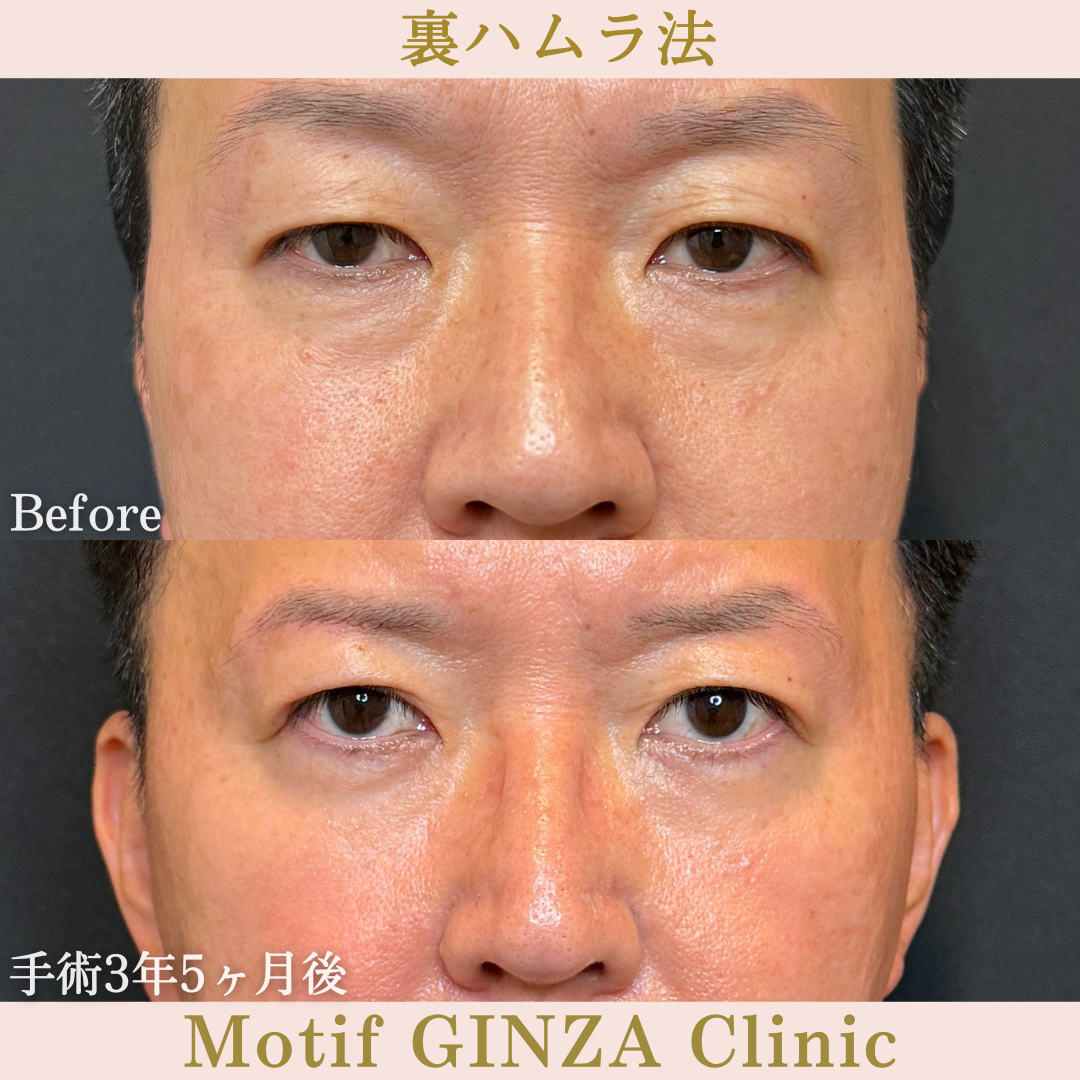 裏ハムラ法（手術3年5ヶ月）の写真