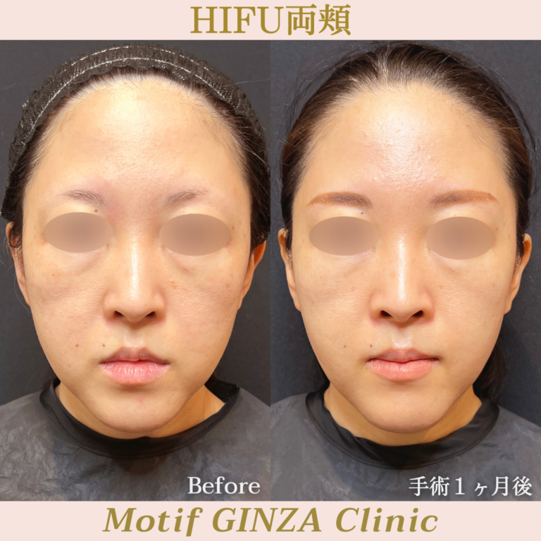 HIFU両頬（手術１ヶ月）の写真