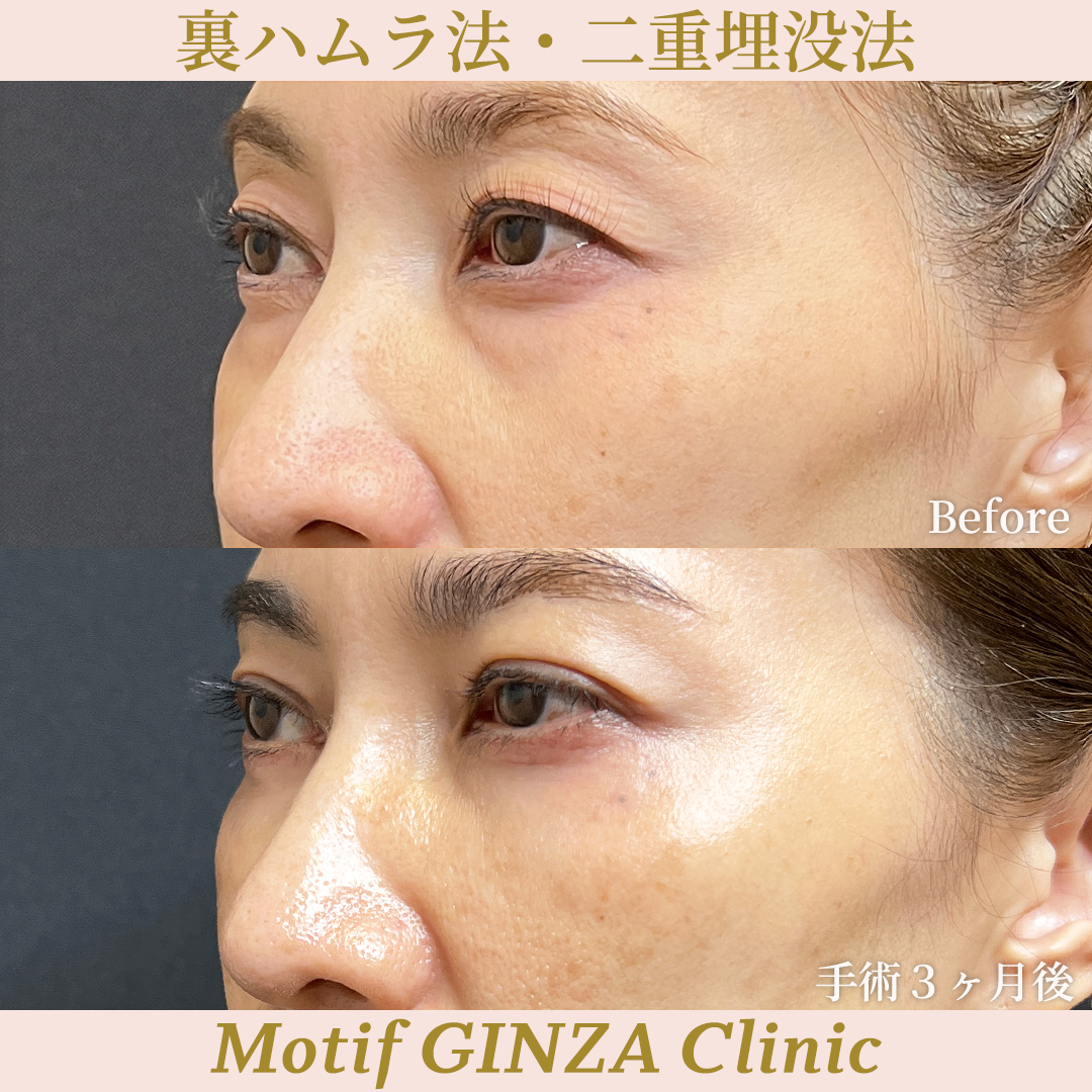 裏ハムラ法・二重埋没法（手術３ヶ月）の写真3