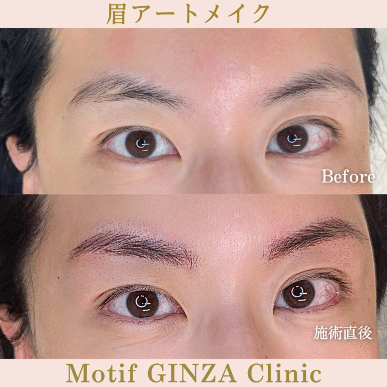 眉アートメイク(施術直後)