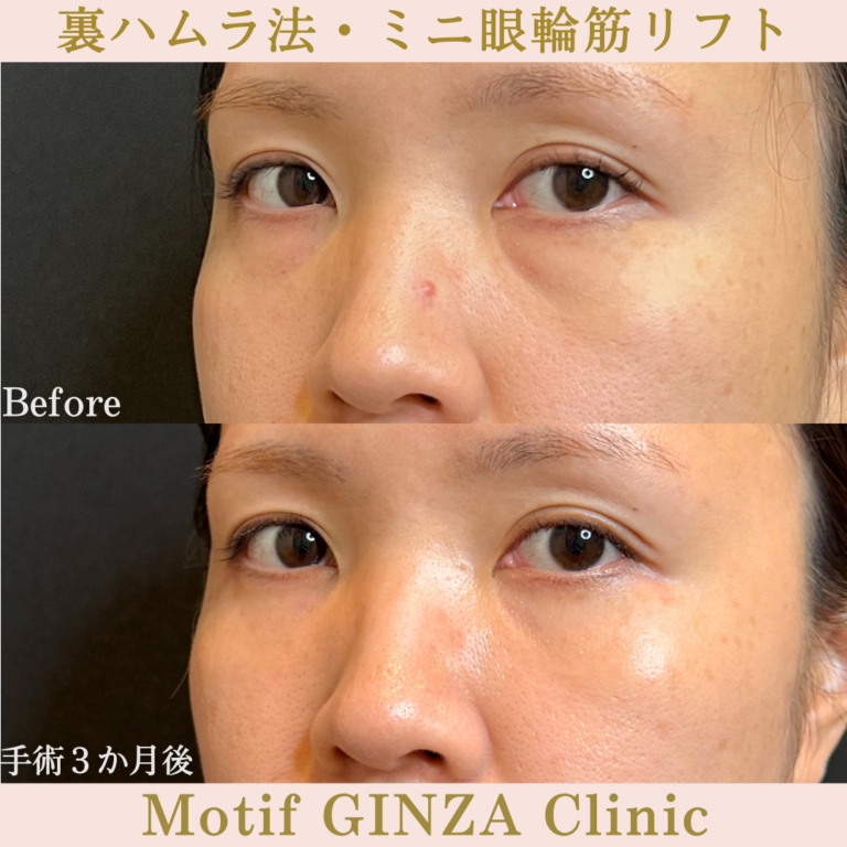 裏ハムラ法・ミニ眼輪筋リフト（手術3か月）の写真2