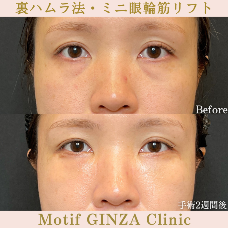 裏ハムラ法・ミニ眼輪筋リフト(手術1か月)の写真3