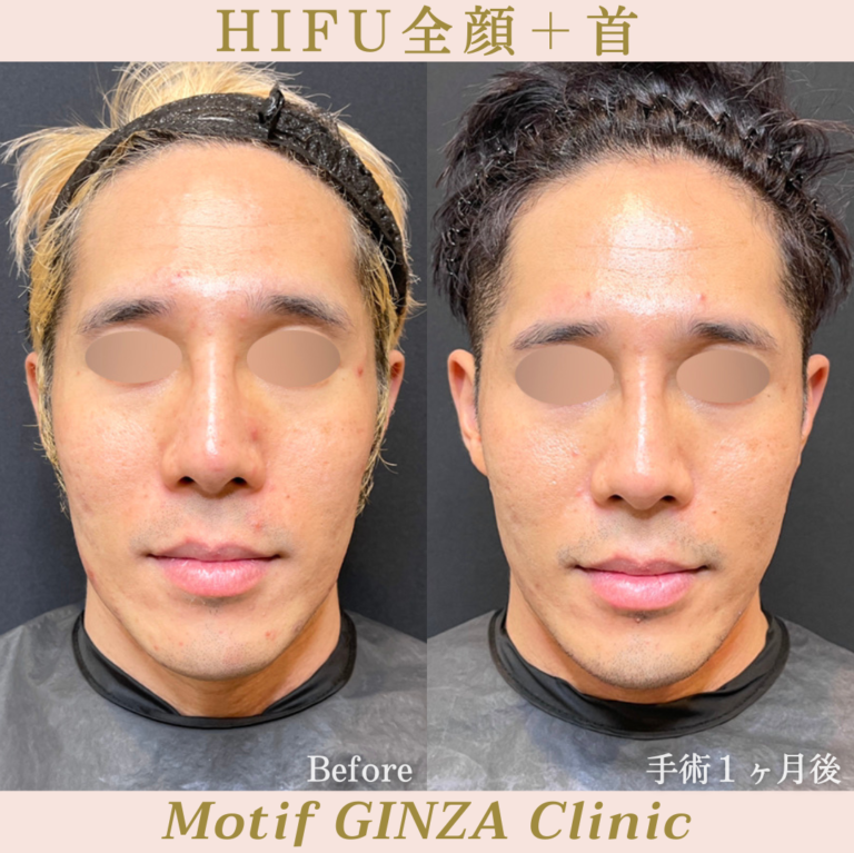 HIFU全顔＋首（手術１ヶ月）の写真1