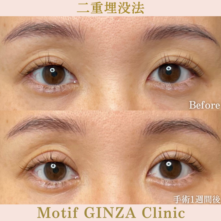 二重埋没法法（手術1か月）の写真2