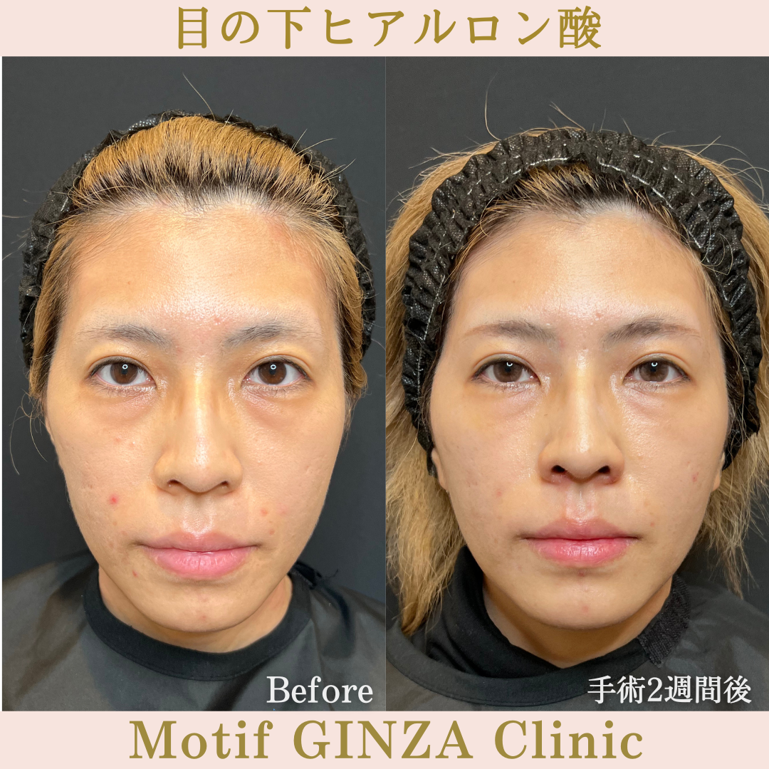 目の下ヒアルロン酸（手術２週間）の写真