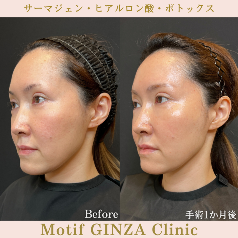 サーマジェン・ヒアルロン酸・ボトックス(手術1か月)の写真2