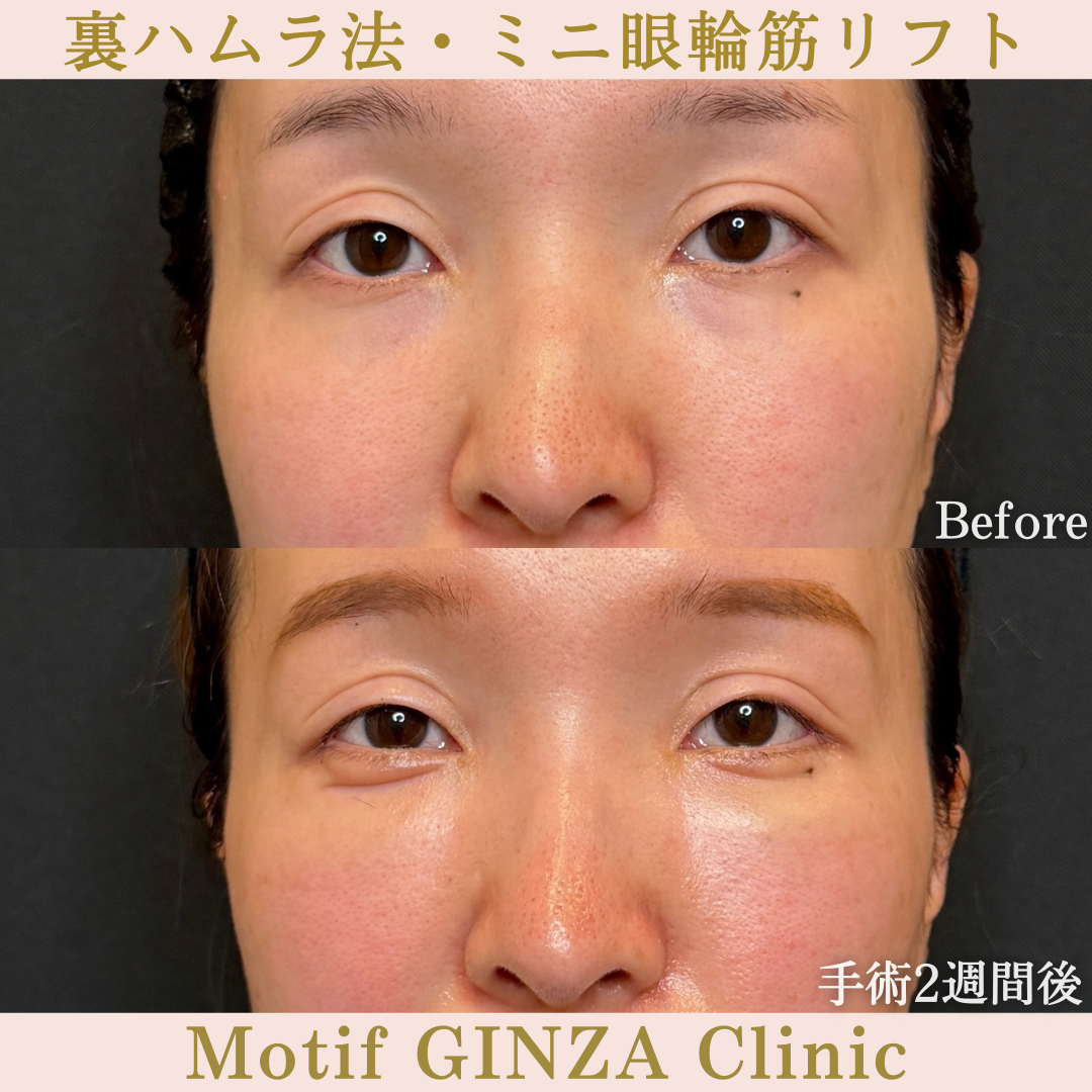 裏ハムラ法・ミニ眼輪筋リフト（手術３か月）の写真5