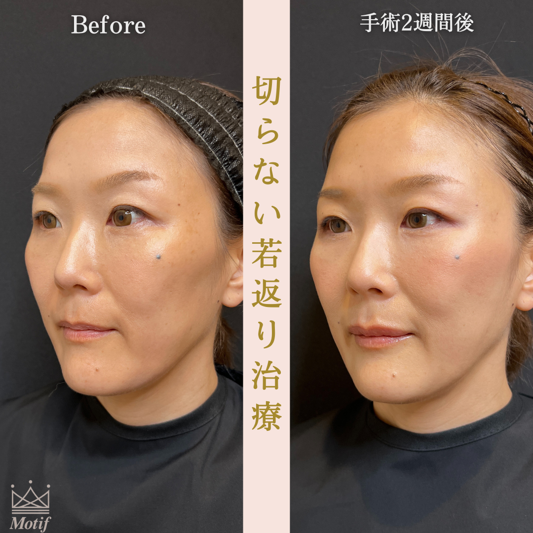 切らない若返り治療(手術2週間)の写真2
