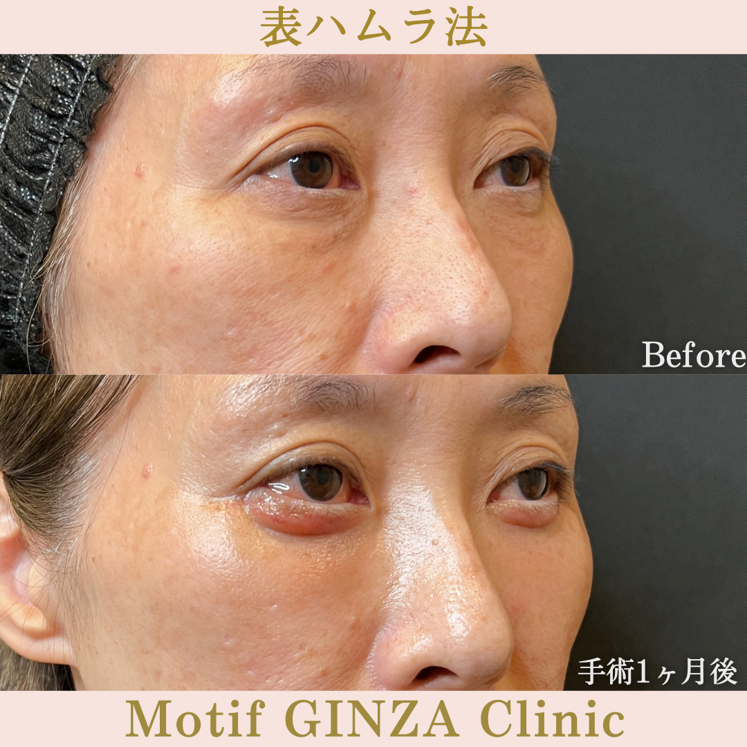切開式下眼瞼たるみ取り（手術６か月）の写真6