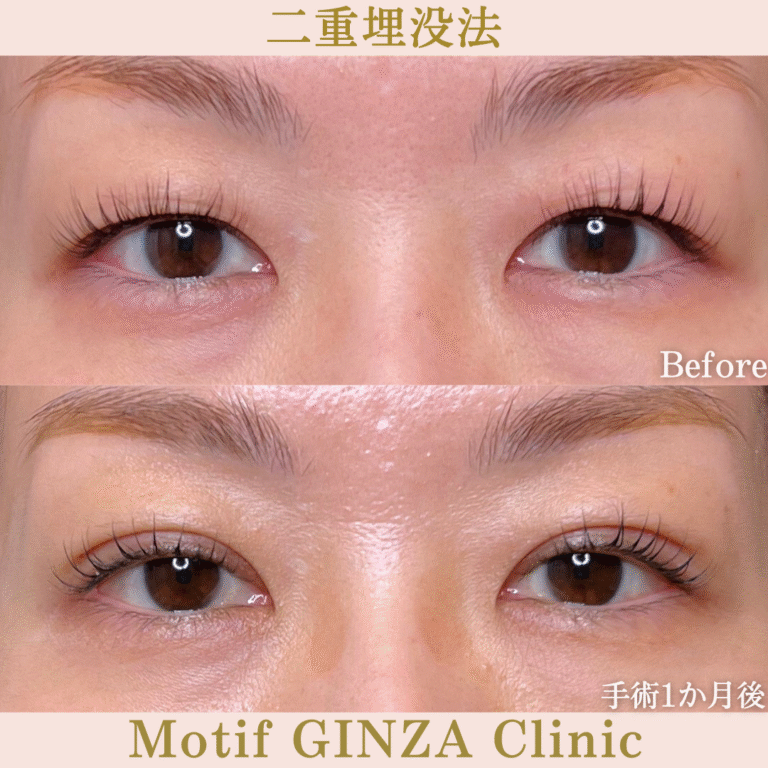 二重埋没法（手術１か月）