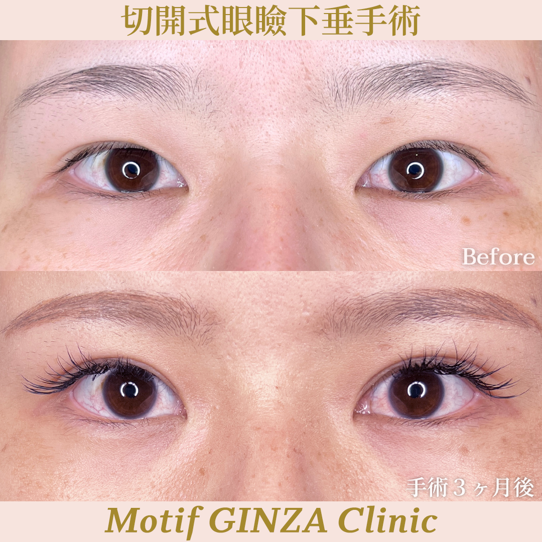 切開式眼瞼下垂手術（手術３ヶ月）の写真