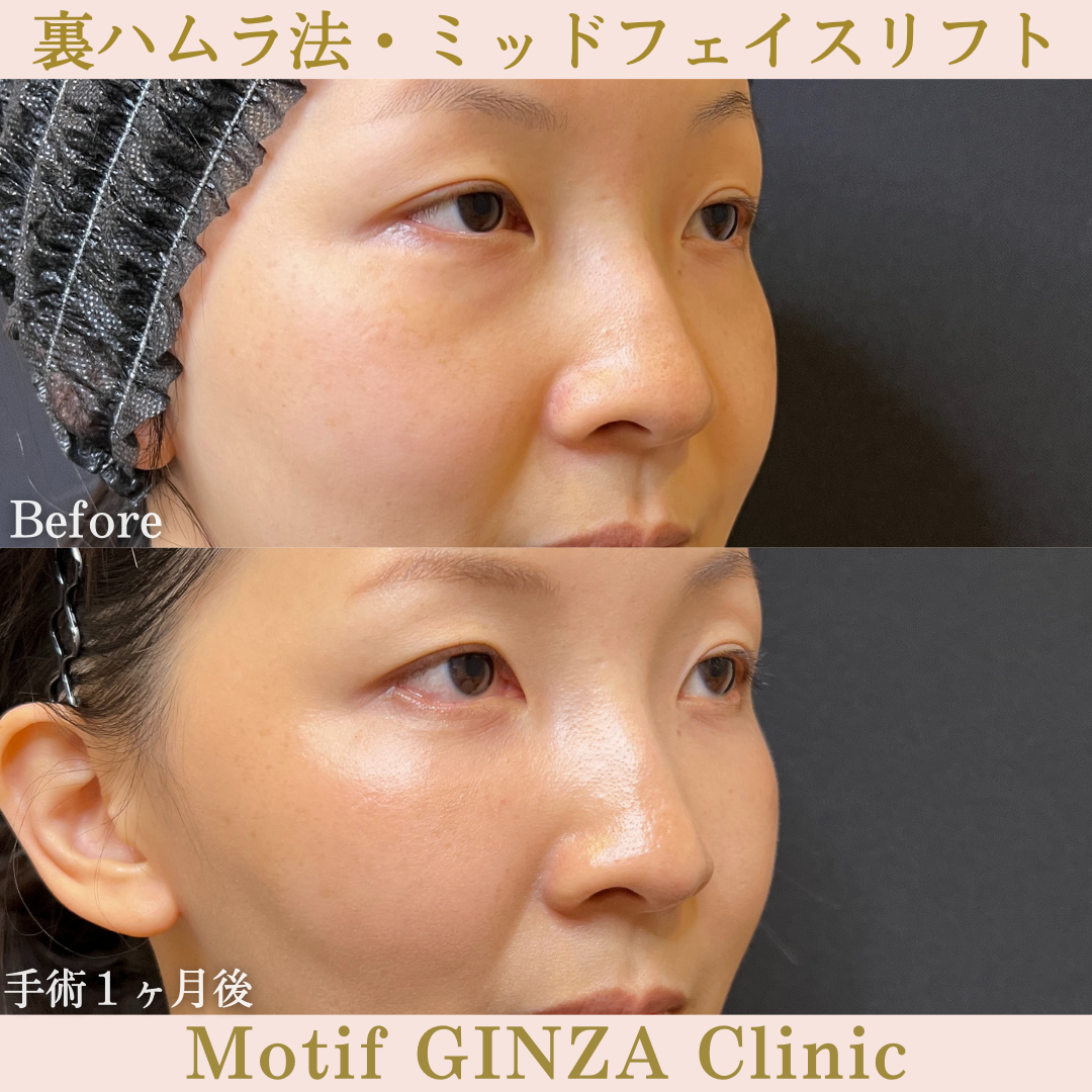 裏ハムラ法・ミッドフェイスリフト（手術３ヶ月）の写真4