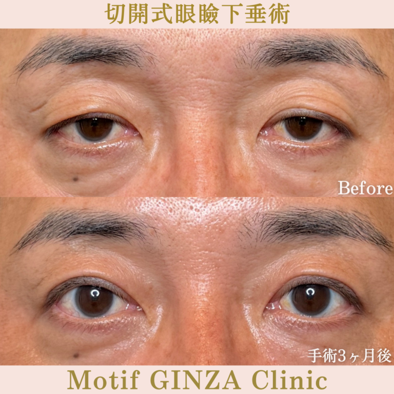 切開式眼瞼下垂手術（手術３か月）