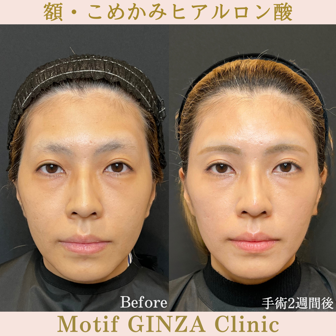 額・こめかみヒアルロン酸（手術2週間）の写真2