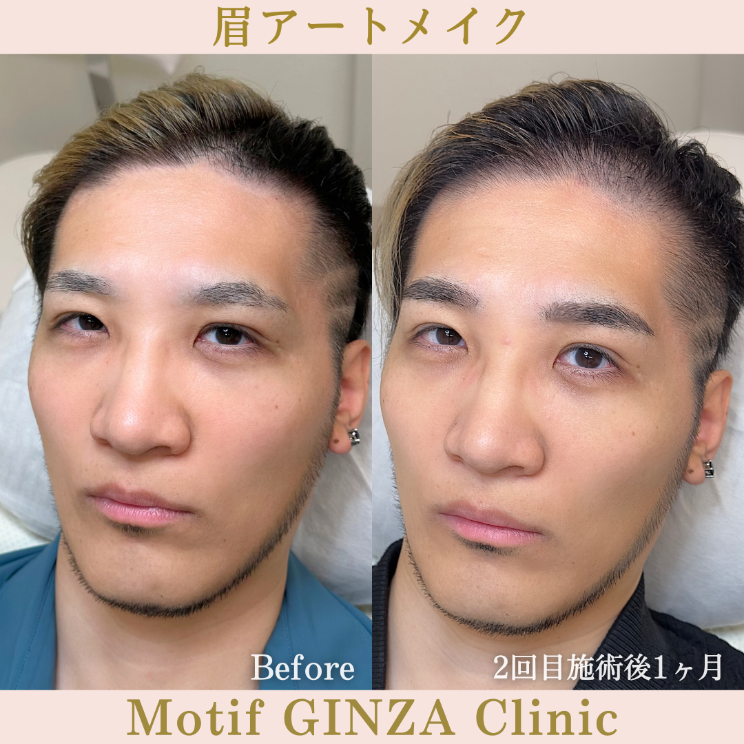 眉アートメイク（施術１か月）の写真