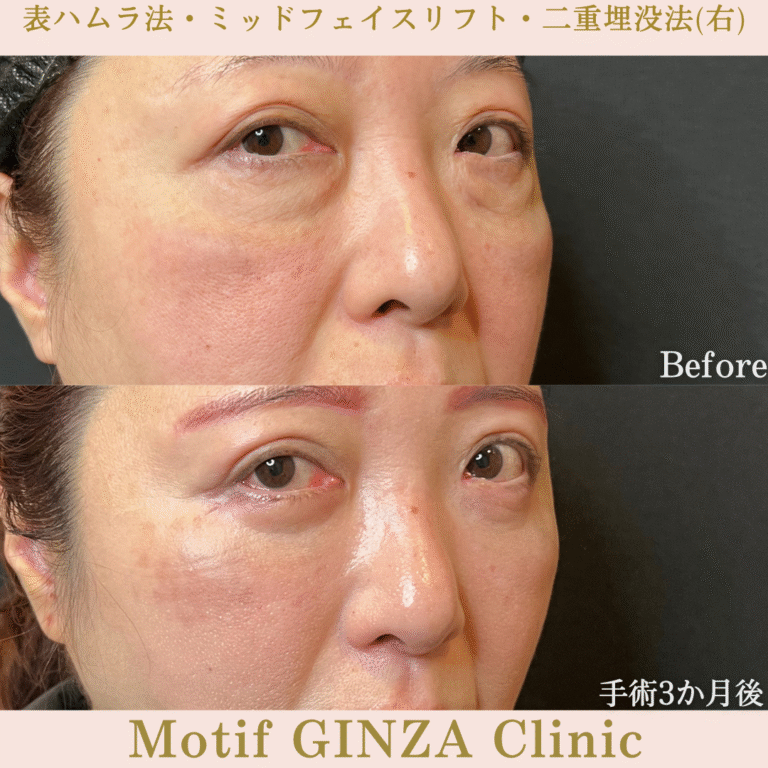 切開式下眼瞼たるみ取り・ミッドフェイスリフト・二重埋没法（手術６か月）の写真4