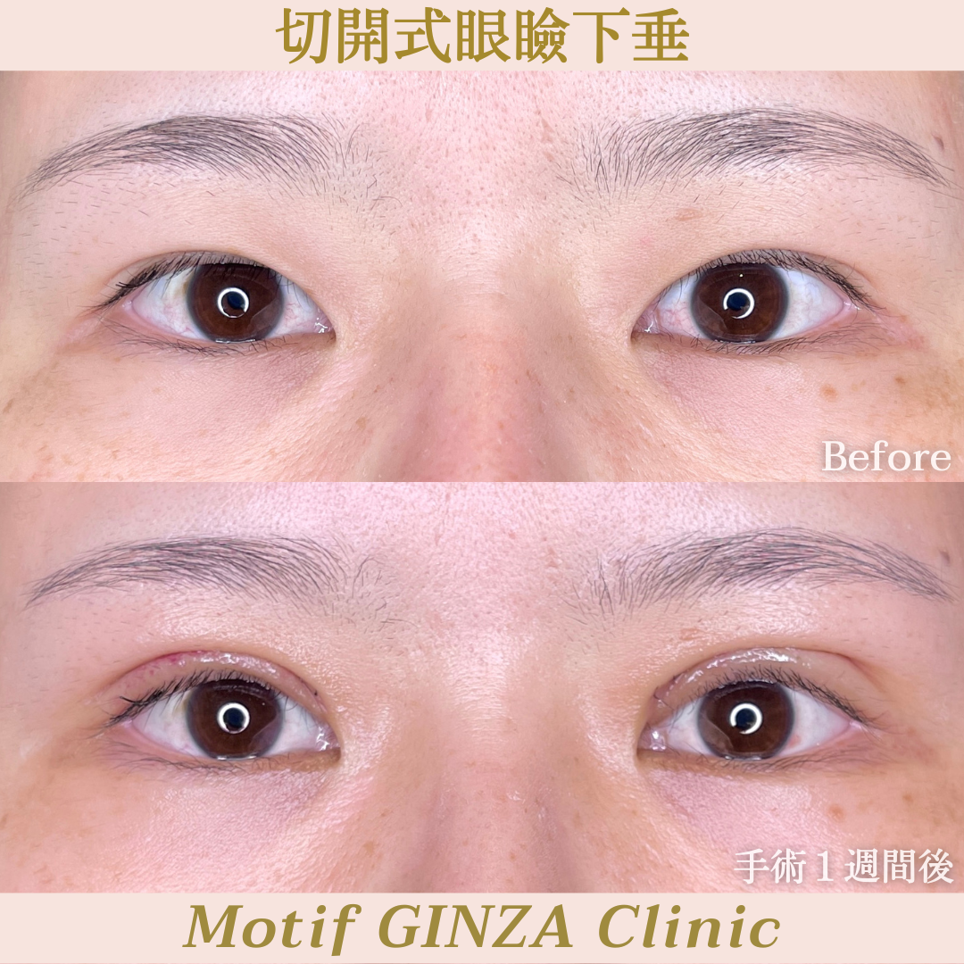 切開式眼瞼下垂手術（手術３ヶ月）の写真4