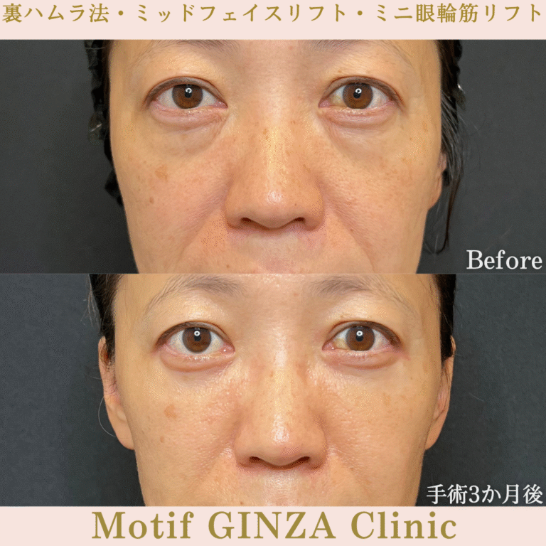 裏ハムラ法・ミッドフェイスリフト・ミニ眼輪筋リフト(手術1か月)