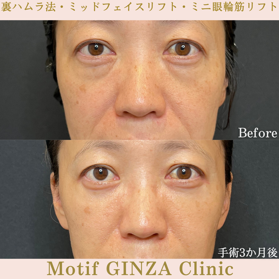 裏ハムラ法・ミッドフェイスリフト・ミニ眼輪筋リフト（手術３か月）の写真3