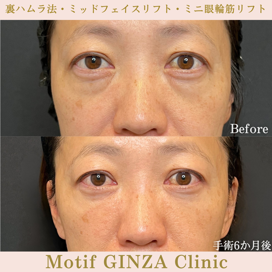 裏ハムラ法・ミッドフェイスリフト・ミニ眼輪筋リフト（手術３か月）の写真