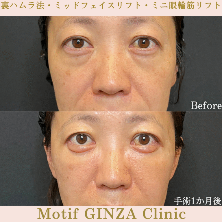 裏ハムラ法・ミッドフェイスリフト・ミニ眼輪筋リフト(手術1か月)