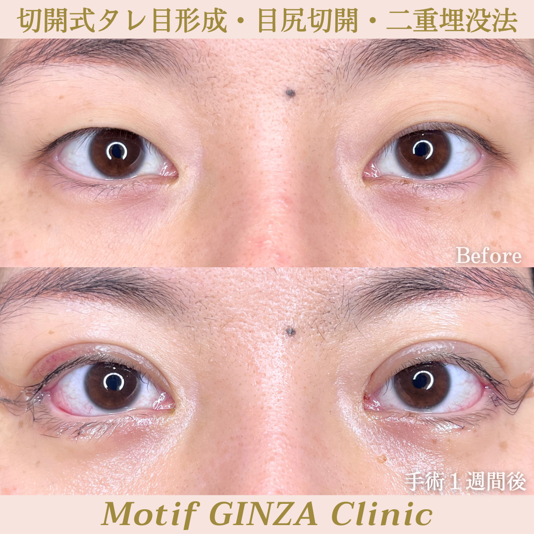 タレ目形成・目尻切開・二重埋没法(手術3ヶ月)の写真5