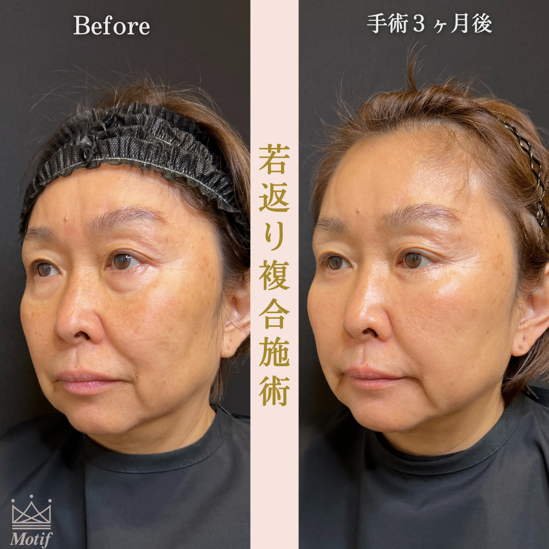若返り複合施術（手術３ヶ月）の写真2